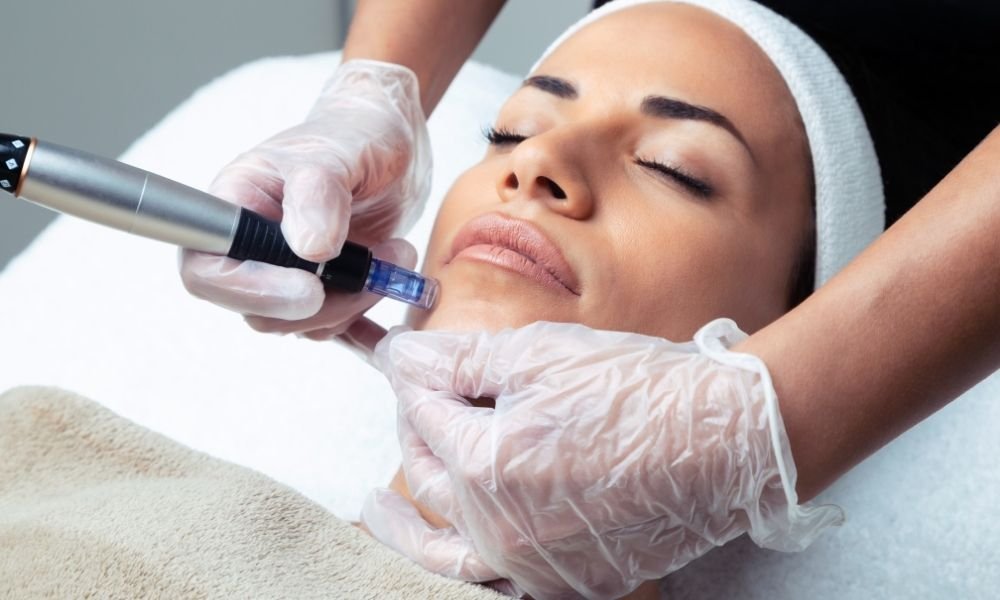 Microneedling